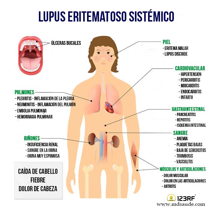 Extraído de- http---www.mdsaude.com-es-2015-12-lupus-eritematoso-sistemico.html